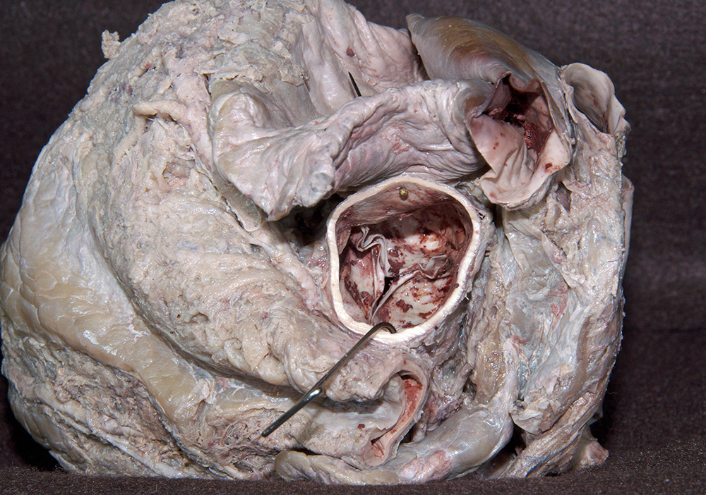Aortic Valve