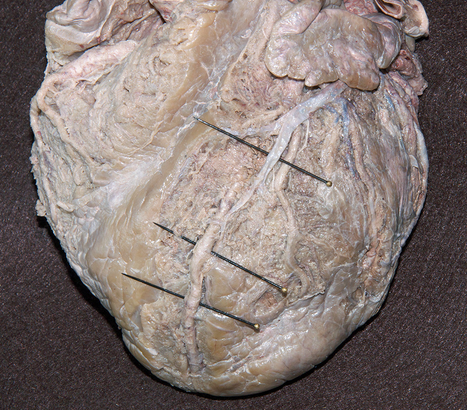 Anterior Interventricular Artery