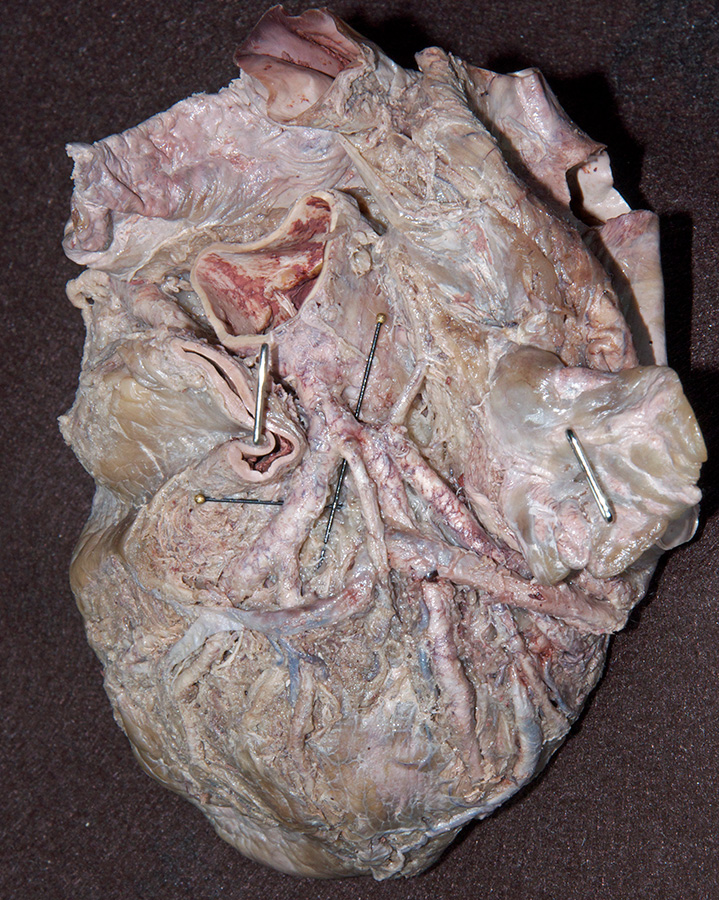 Left Coronary Artery