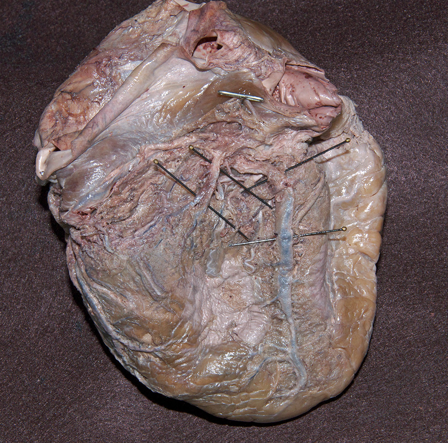 Coronary Sinus