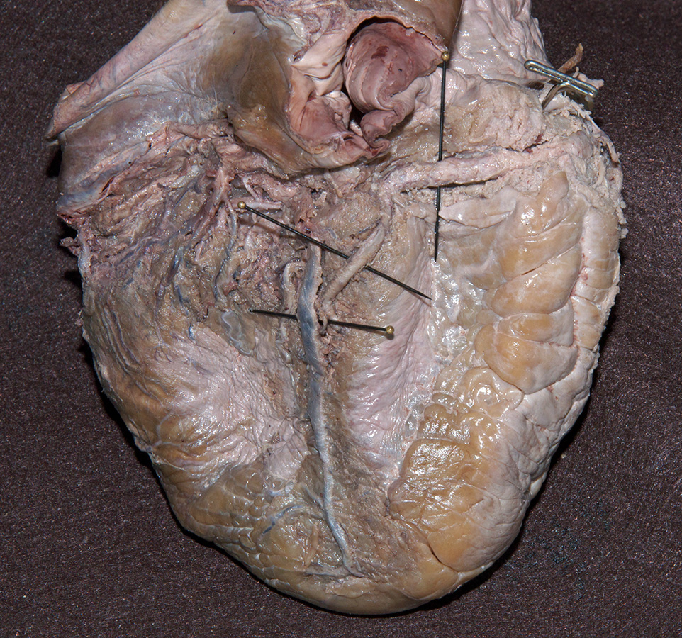 Posterior Interventricular Artery