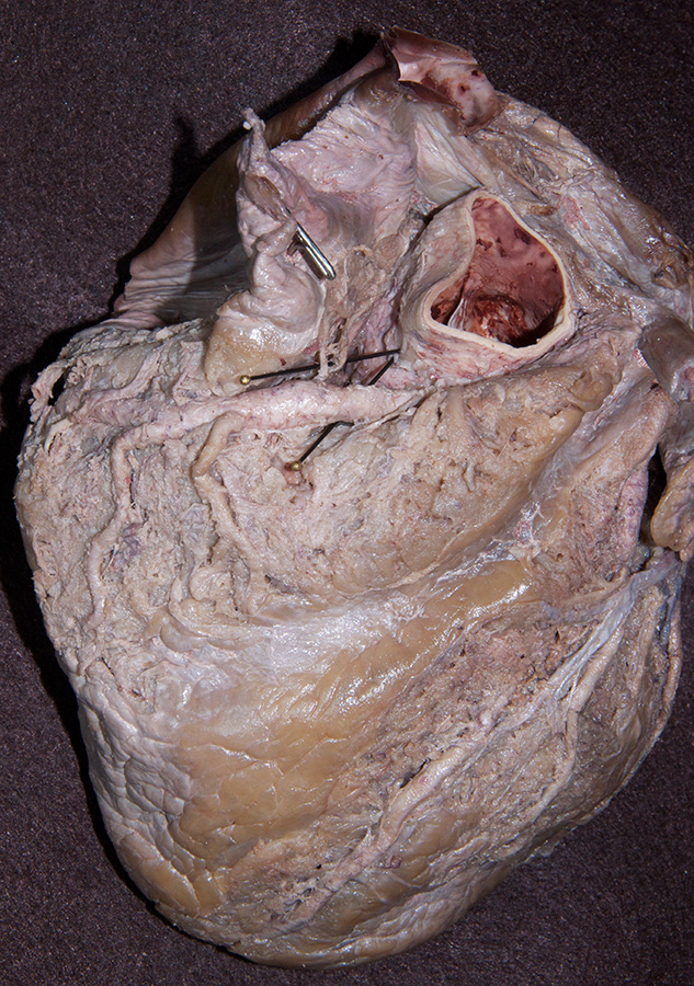 Right Coronary Artery