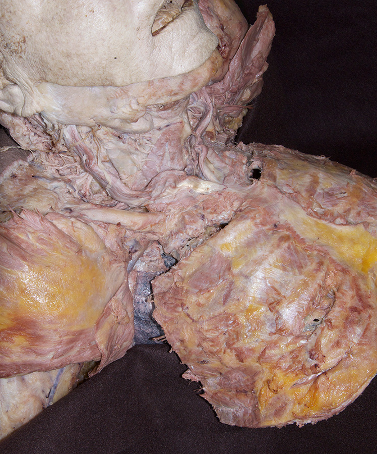 Anterior Thoracic Wall