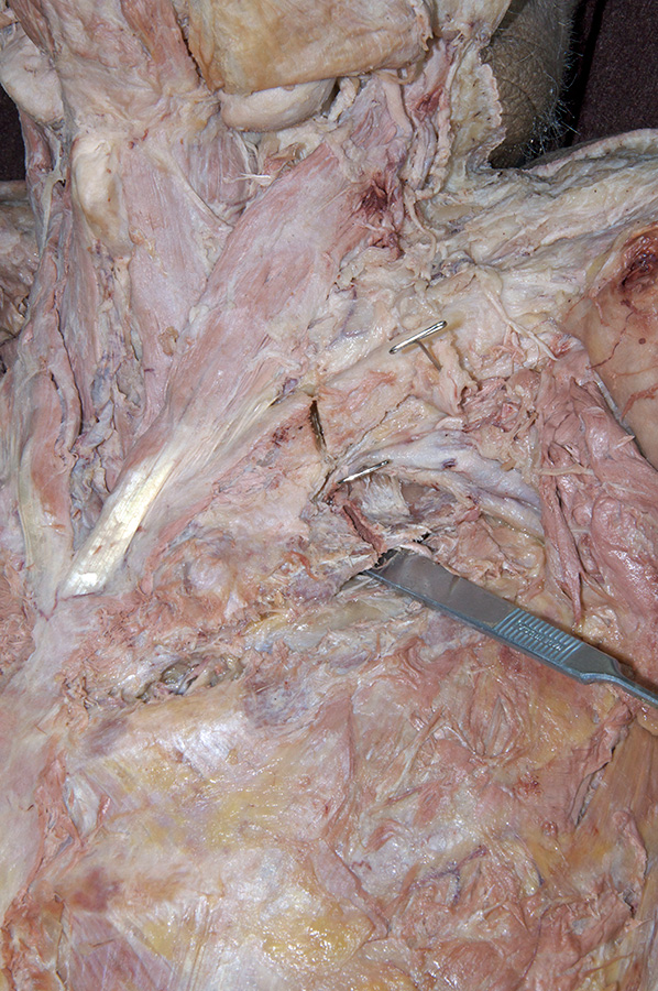 Cut in 1st rib