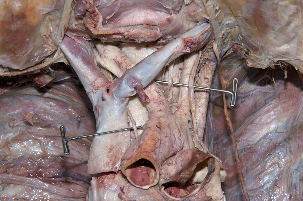 Sympathetic Cervical Cardiac Nerves