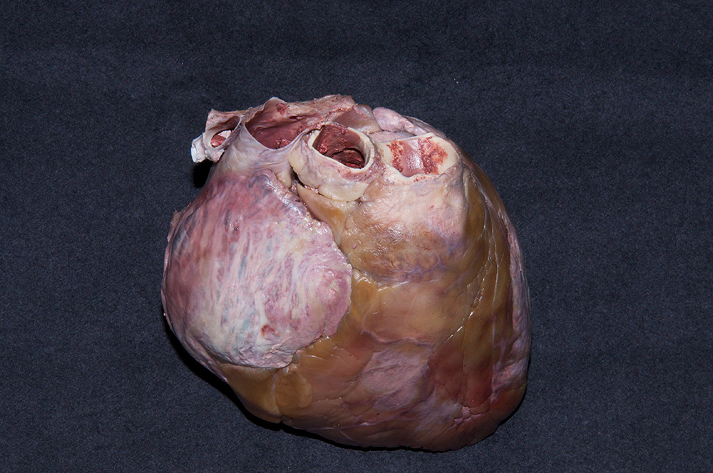 Ascending Aorta