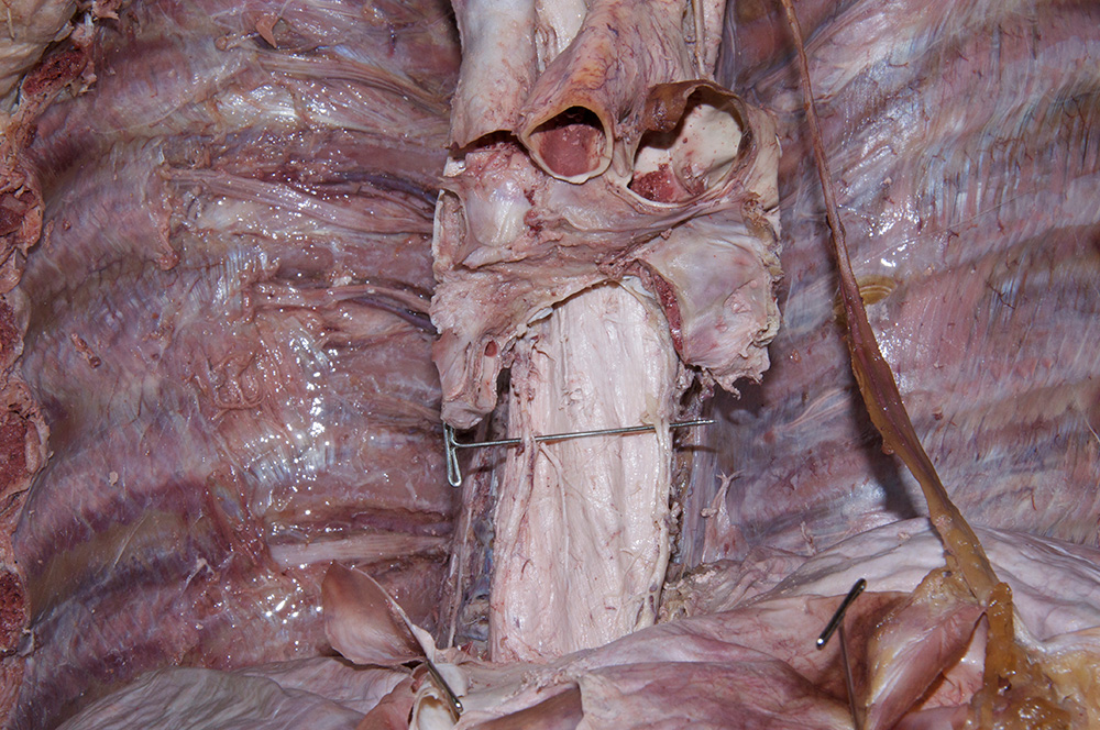 Esophageal Plexus