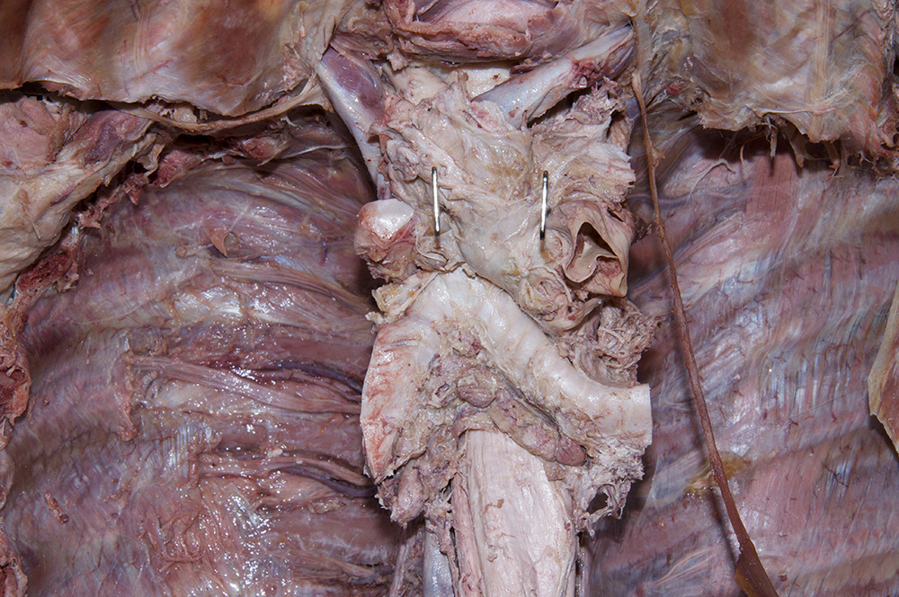 Inferior Tracheobronchial Lymph Nodes