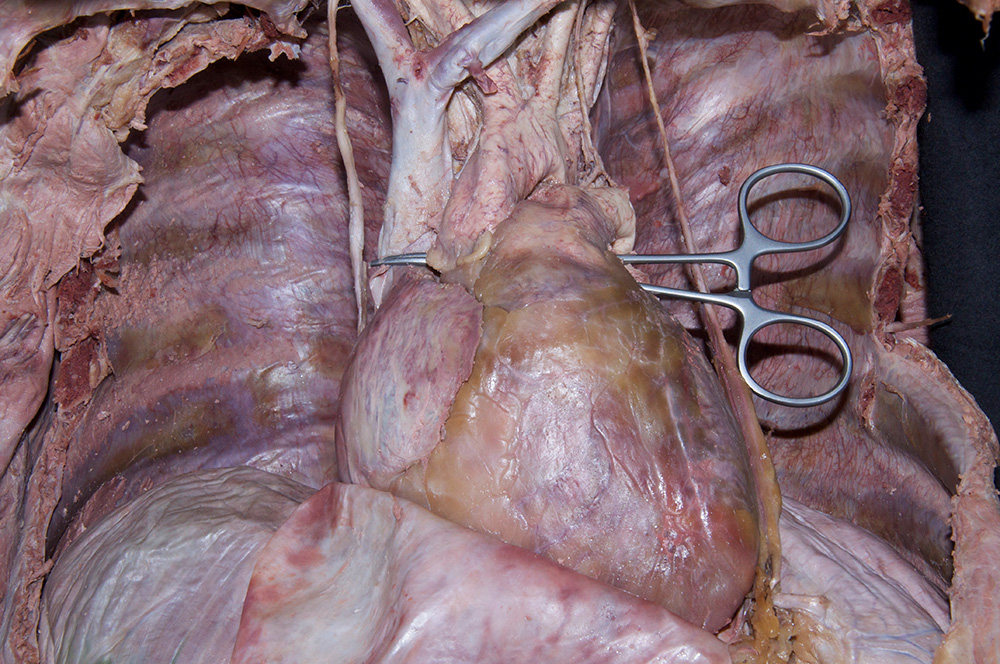 Transverse Pericardial Sinus