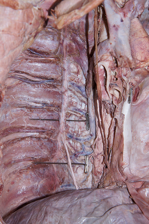 Greater Splanchnic Nerve