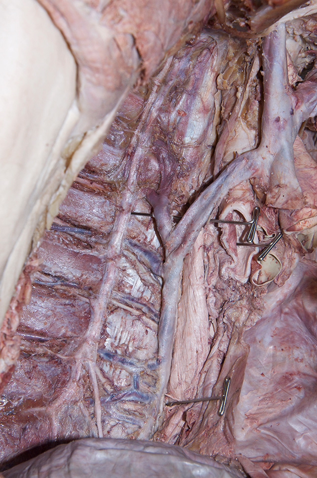 Right Superior Intercostal Vein