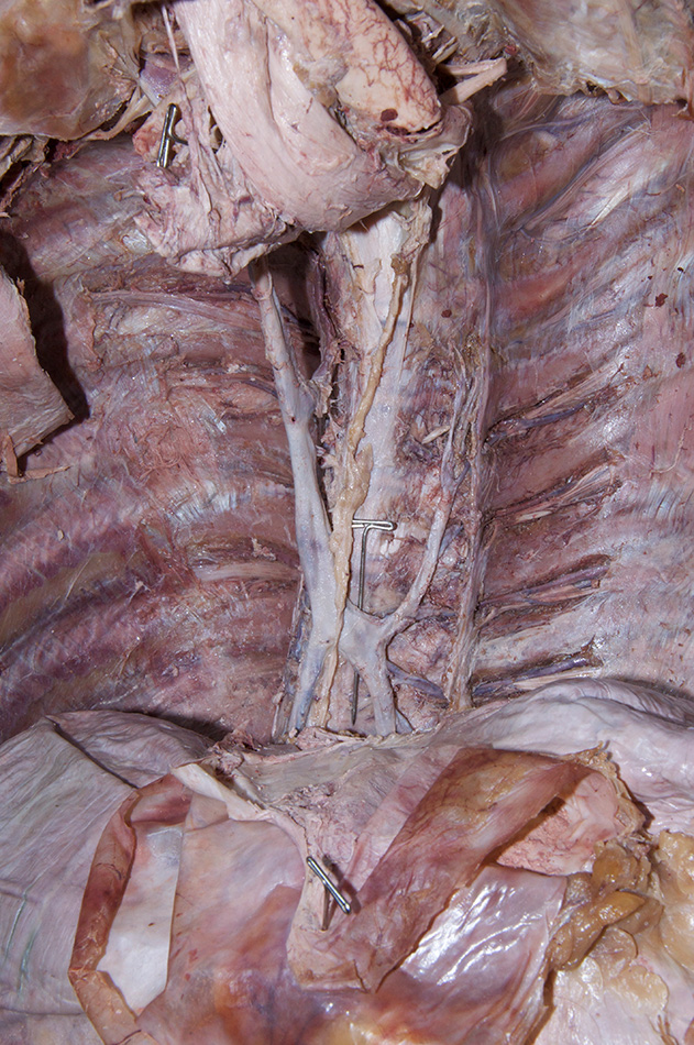 Hemiazygos Vein