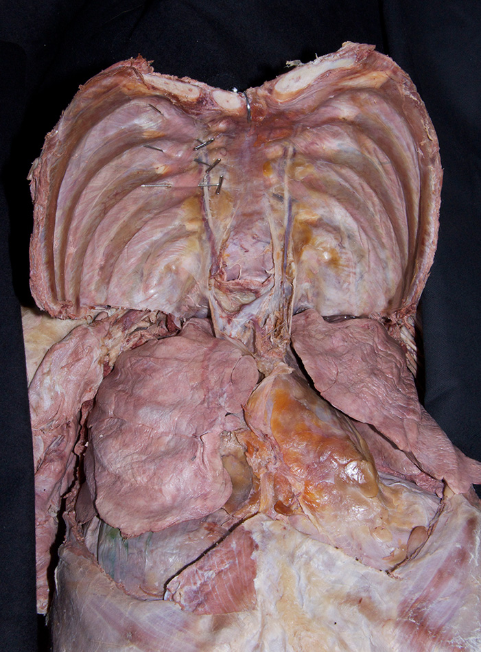 Anterior Thoracic Wall