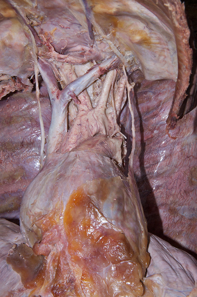 Left Recurrent Laryngeal Nerve