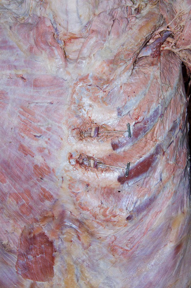 Internal Thoracic Vessels