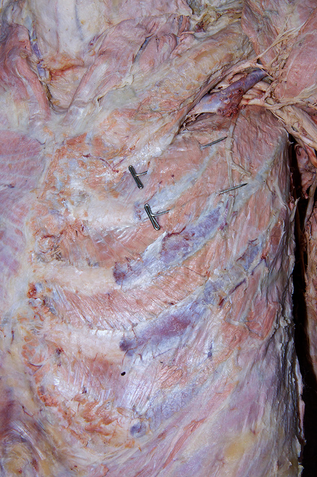 Intercostal Muscles