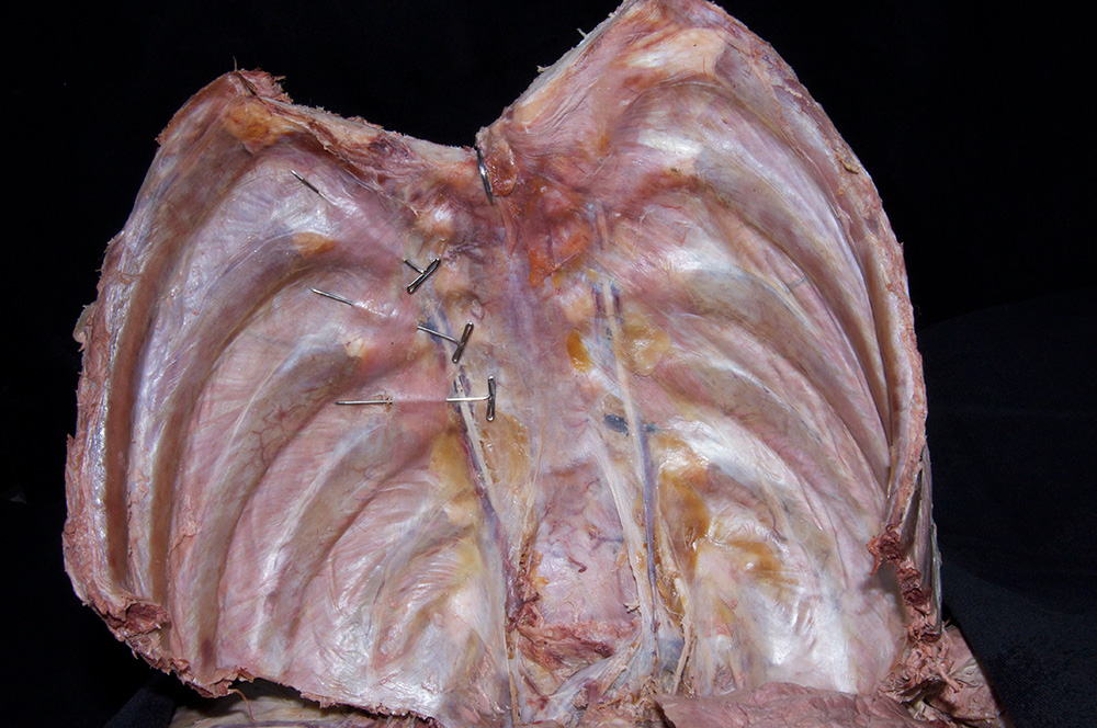 Transversus Thoracis Muscle