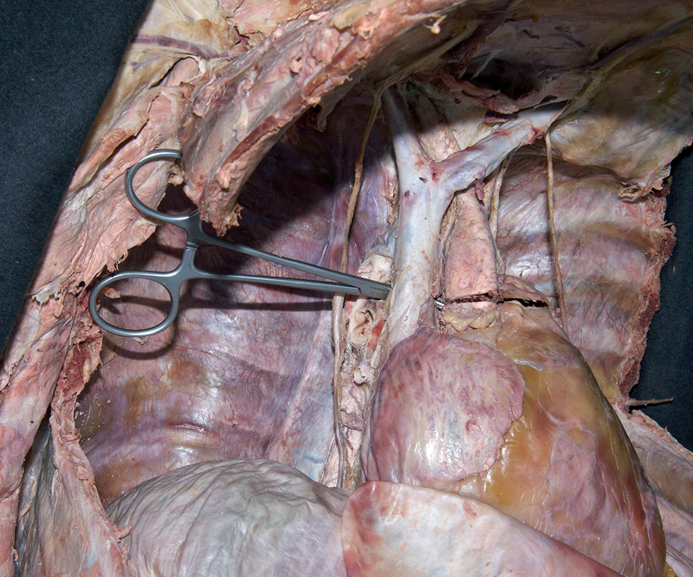 Transcetion of Superior Vena Cava