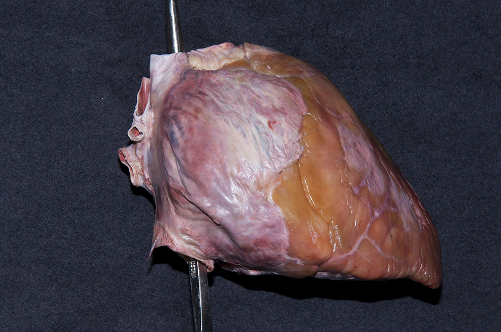 Right Atrium