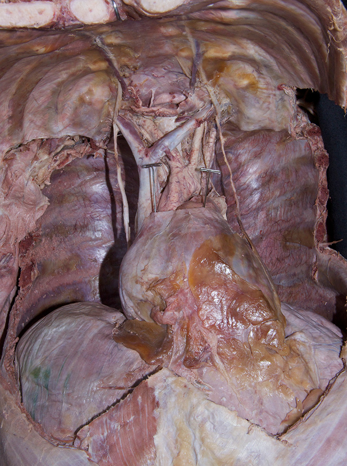 Fibrous Pericardium