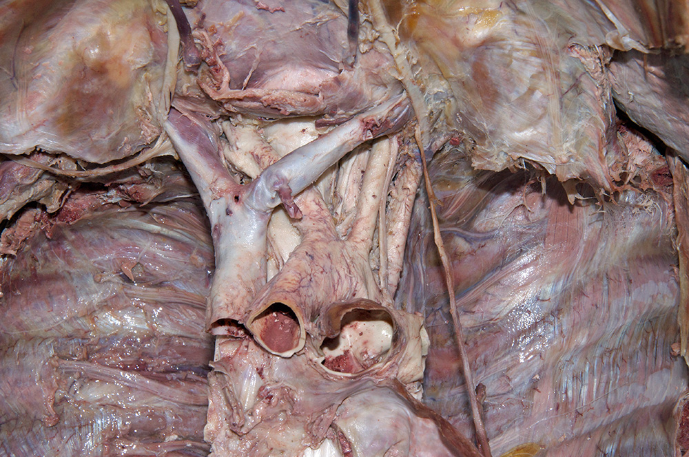 Brachiocephalic Veins
