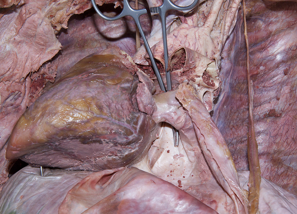 Left Pulmonary Veins