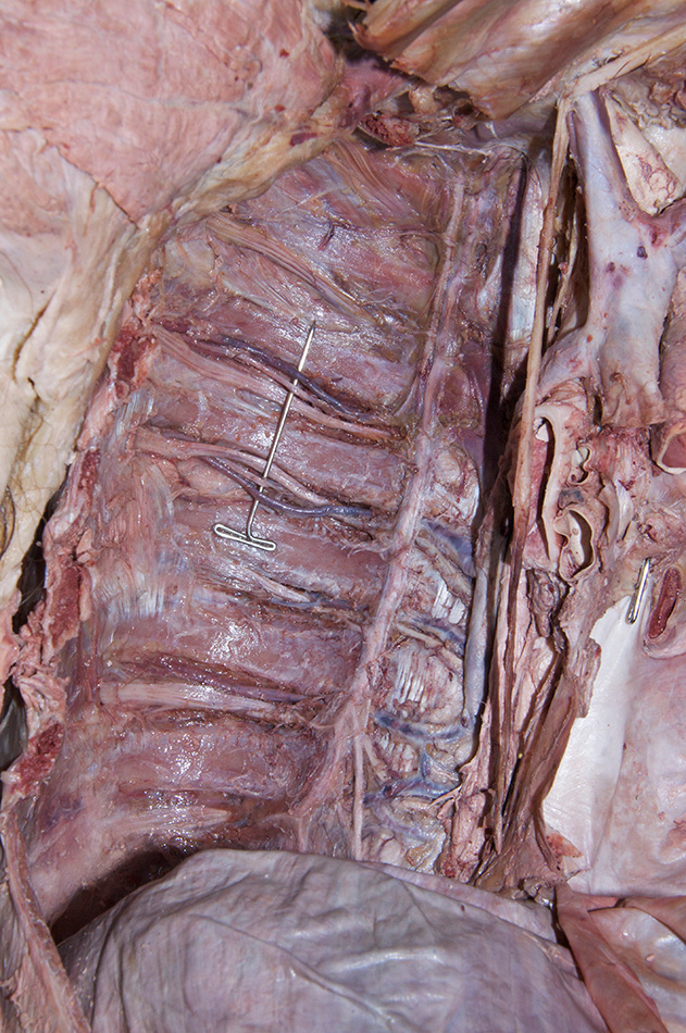 Posterior Intercostal Vessels