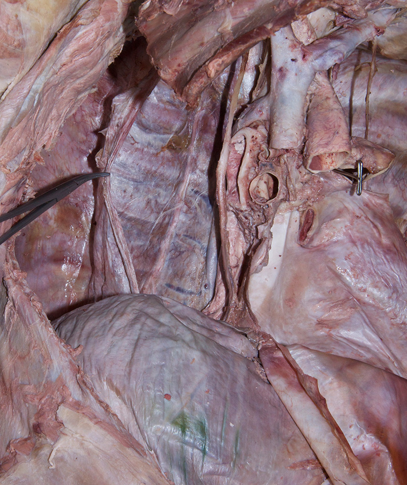 Parietal Pleura