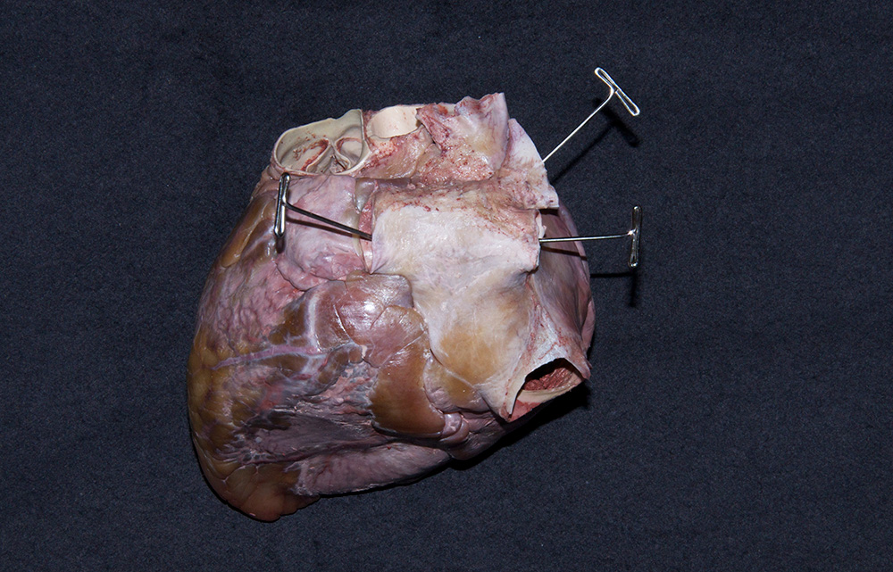 Left Atrium