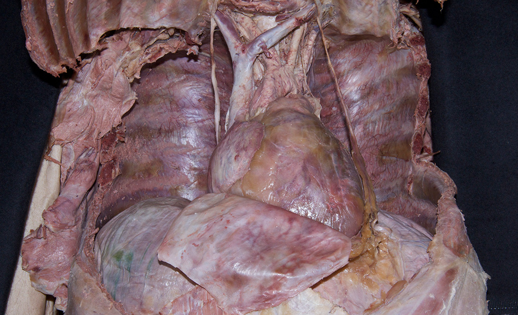 Reflected Pericardial Sac