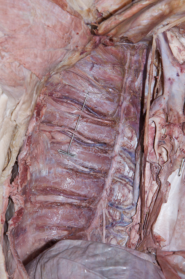 Intercostal Nerve