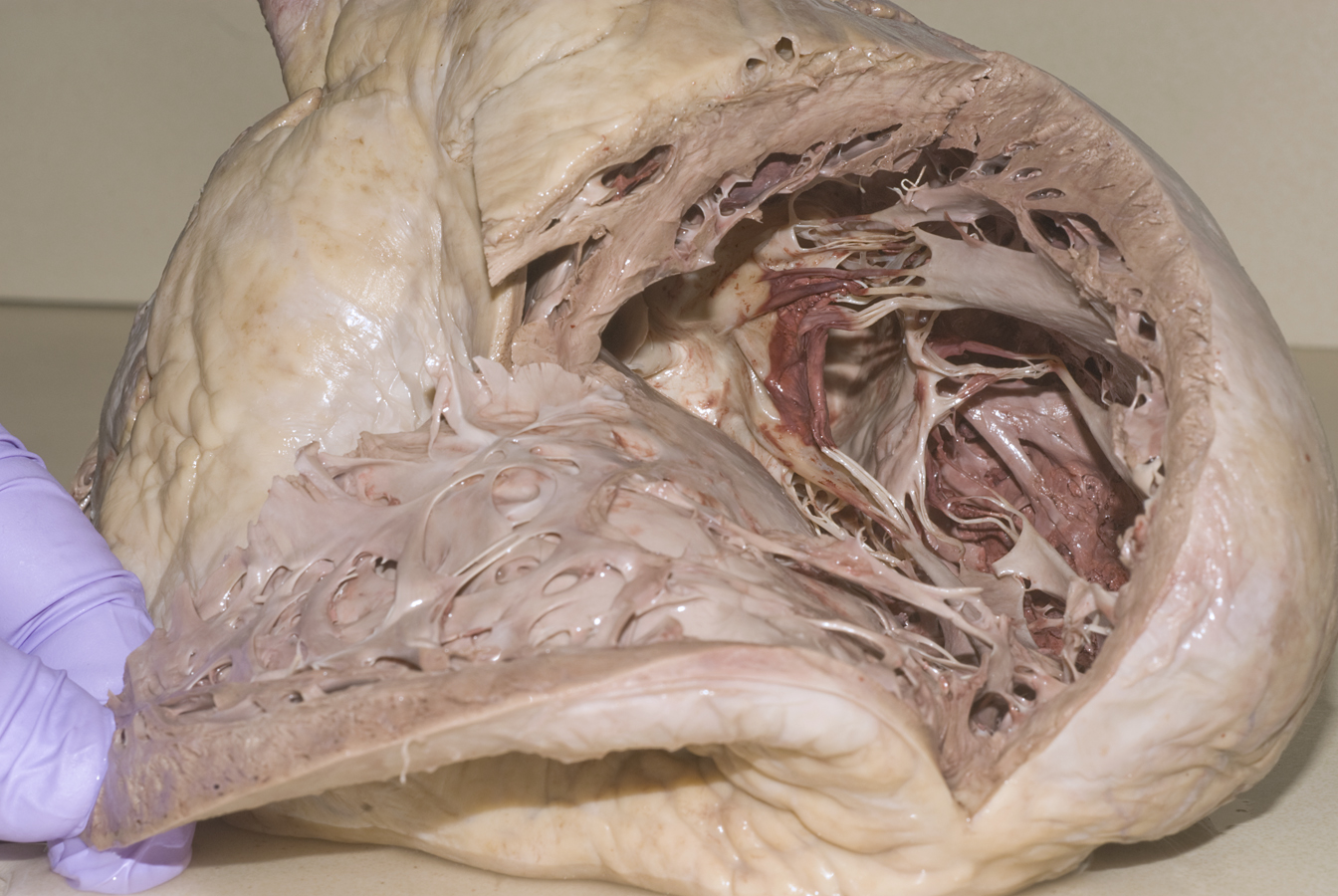 Left Ventricle