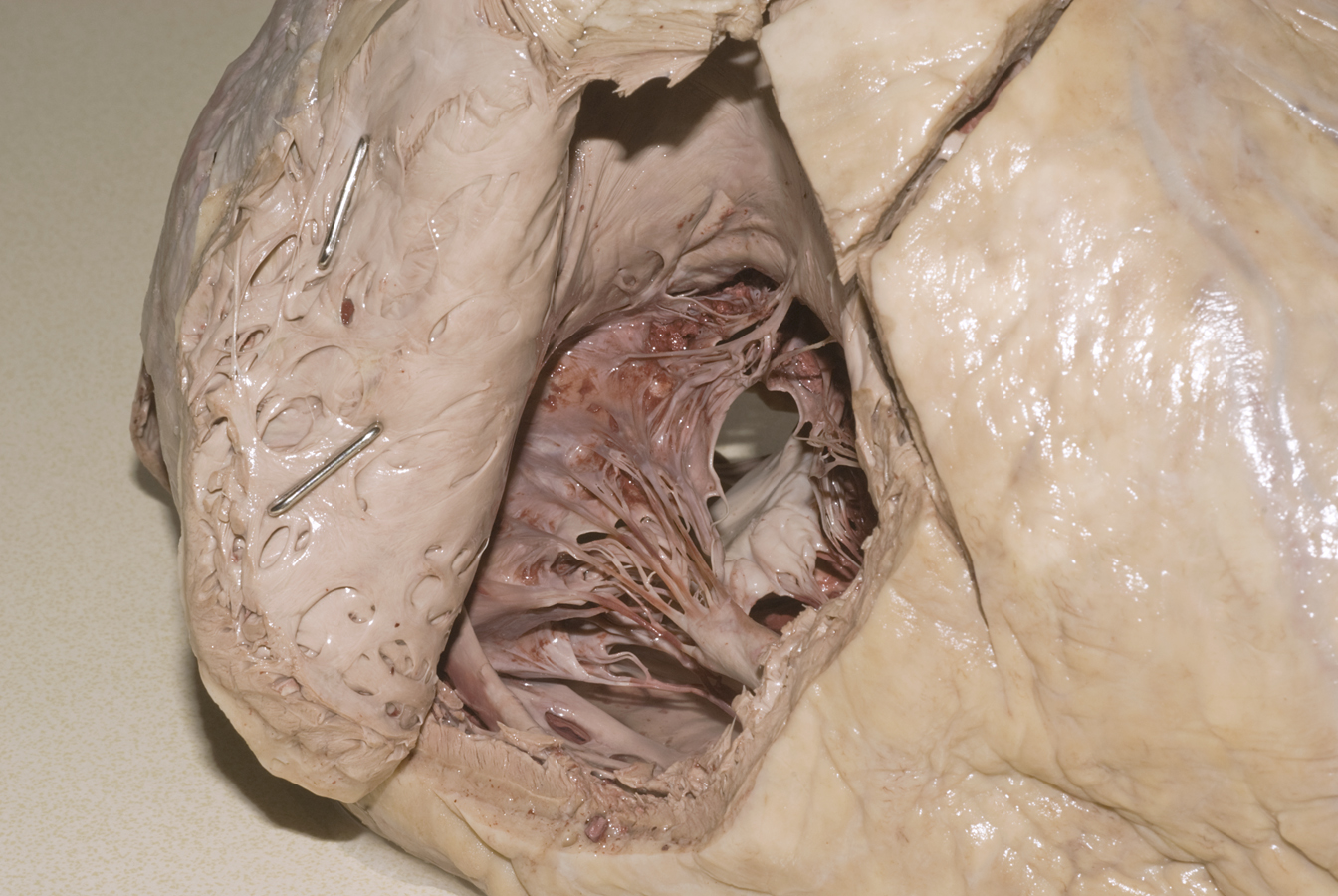 Right Ventricle
