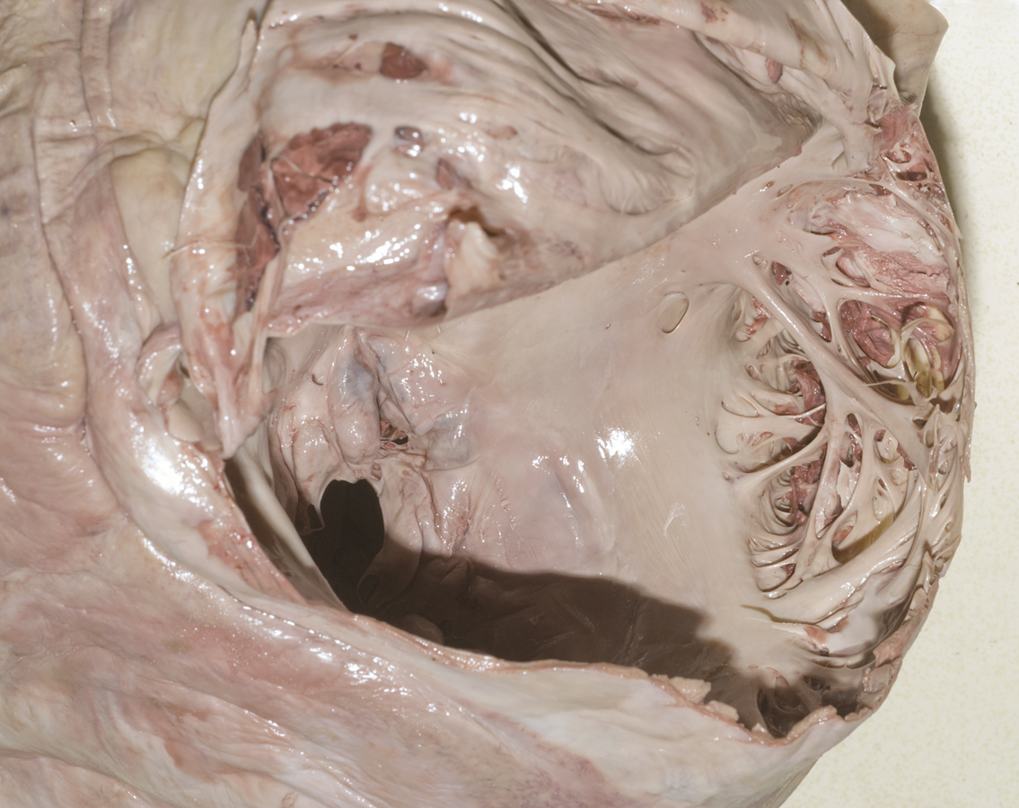 Pectinate muscles