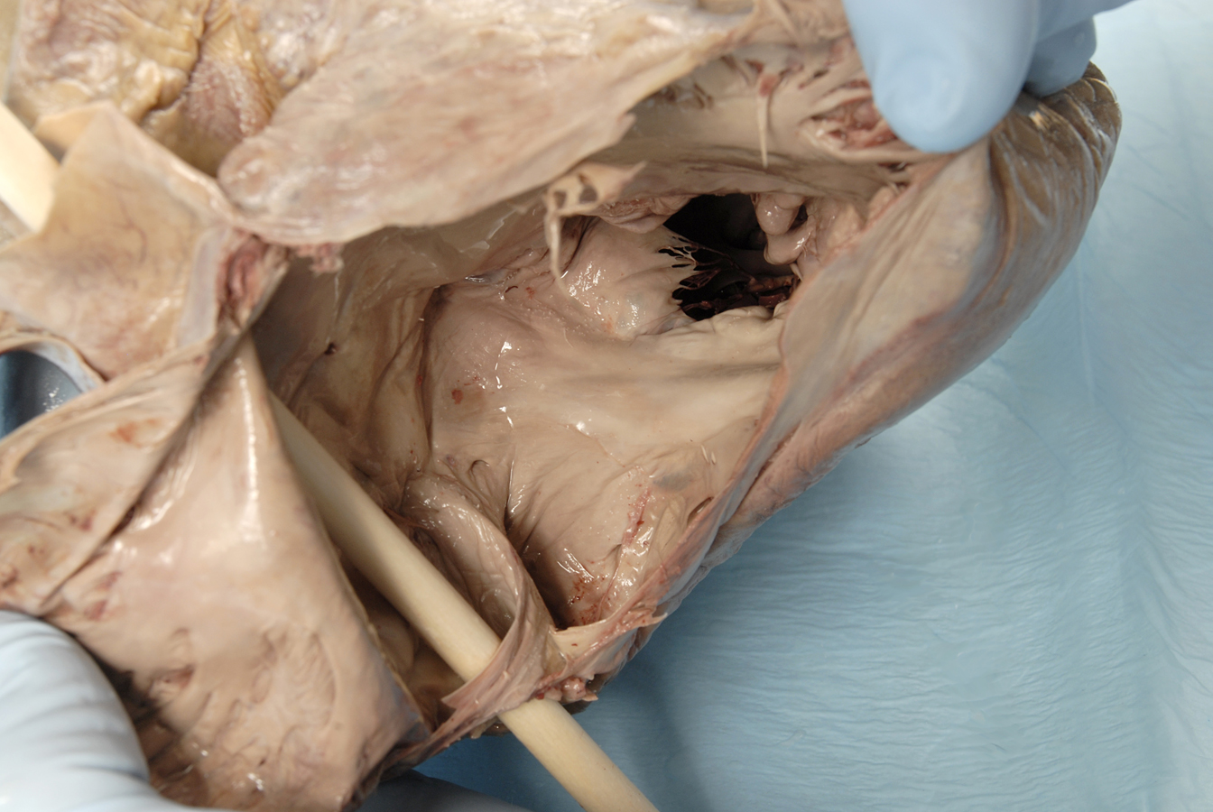 Right Atrioventricular Valve