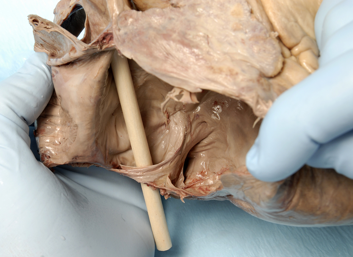 Opening of Coronary Sinus