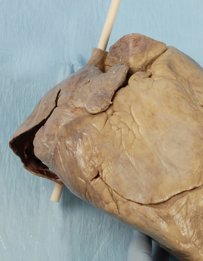 Right Atrium