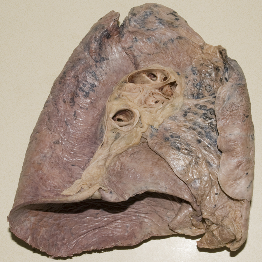 Left Lung Surface Features