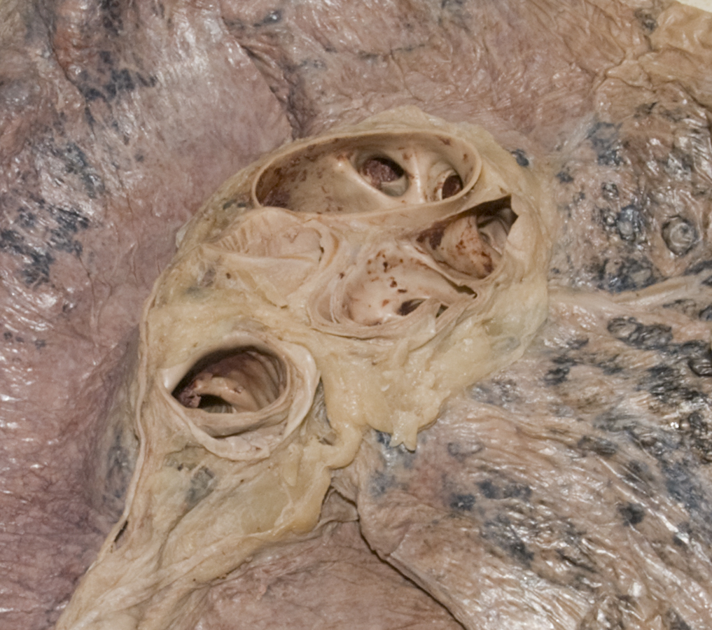 Left Lung (medial view)