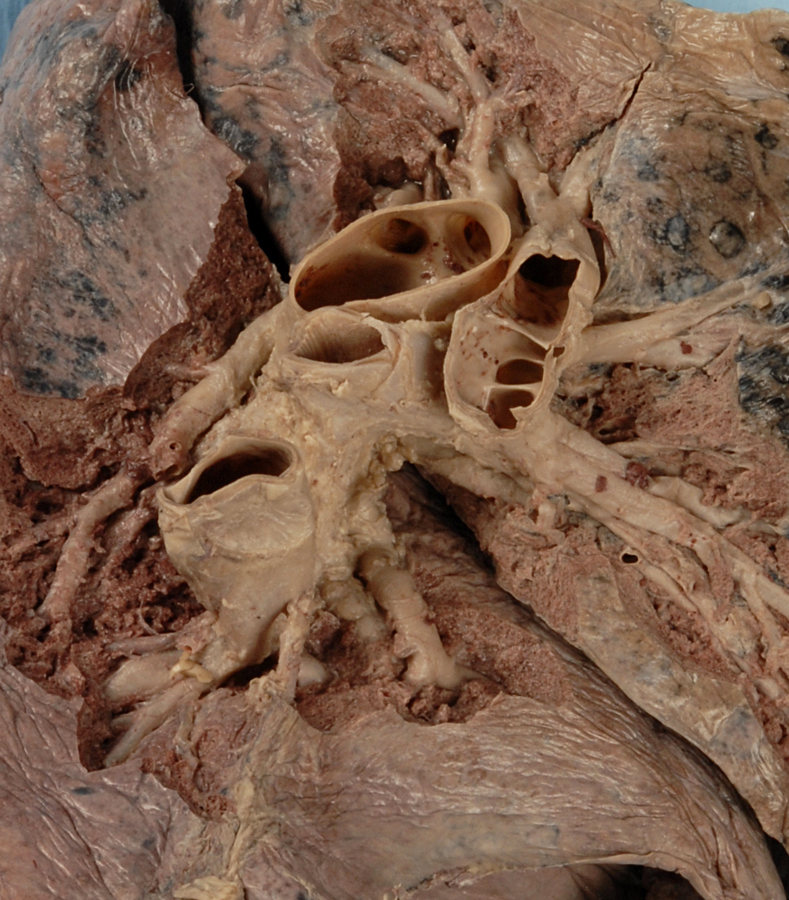 Left Lung Segmental Structures