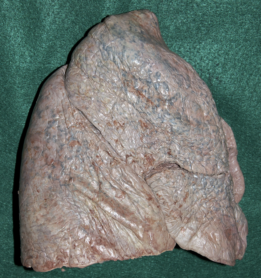Right Lung