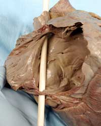 Right Atrium