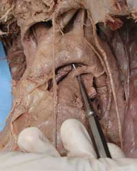 Aortic Arch