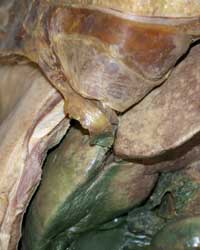 Liver Insitu