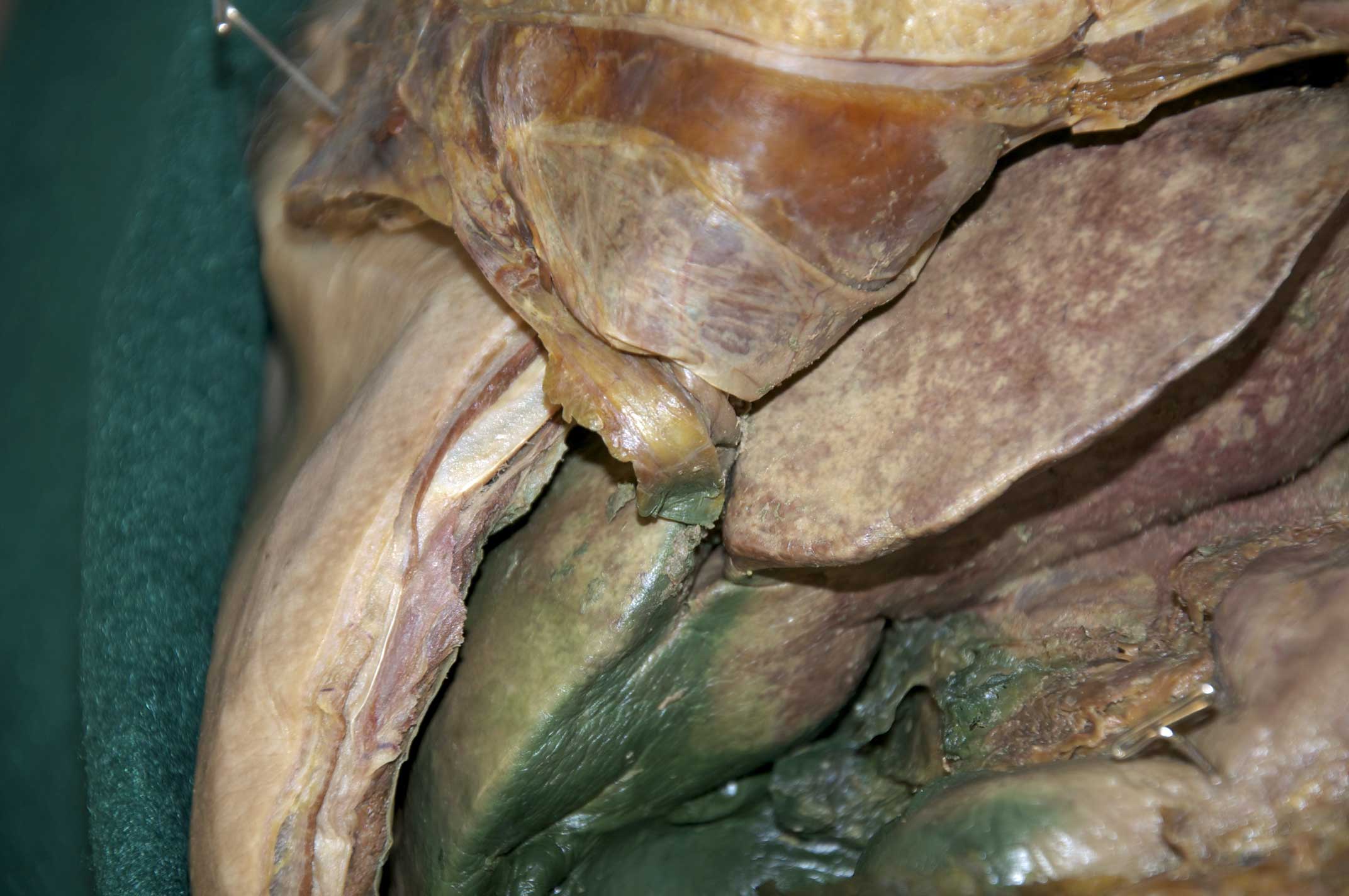 Peritoneal Cavity - 2