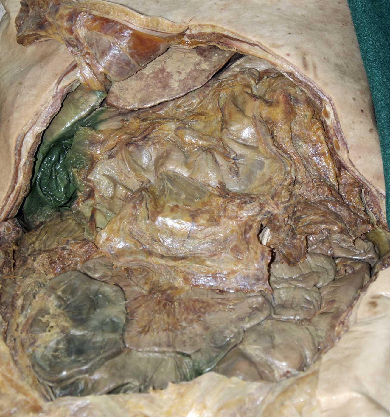 Peritoneal Cavity - 1