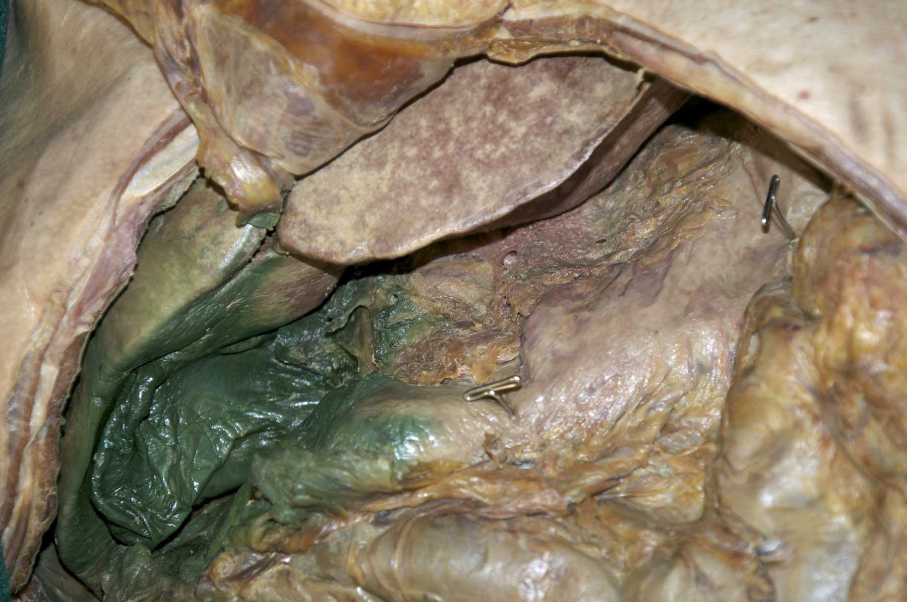 Peritoneal Cavity - 3