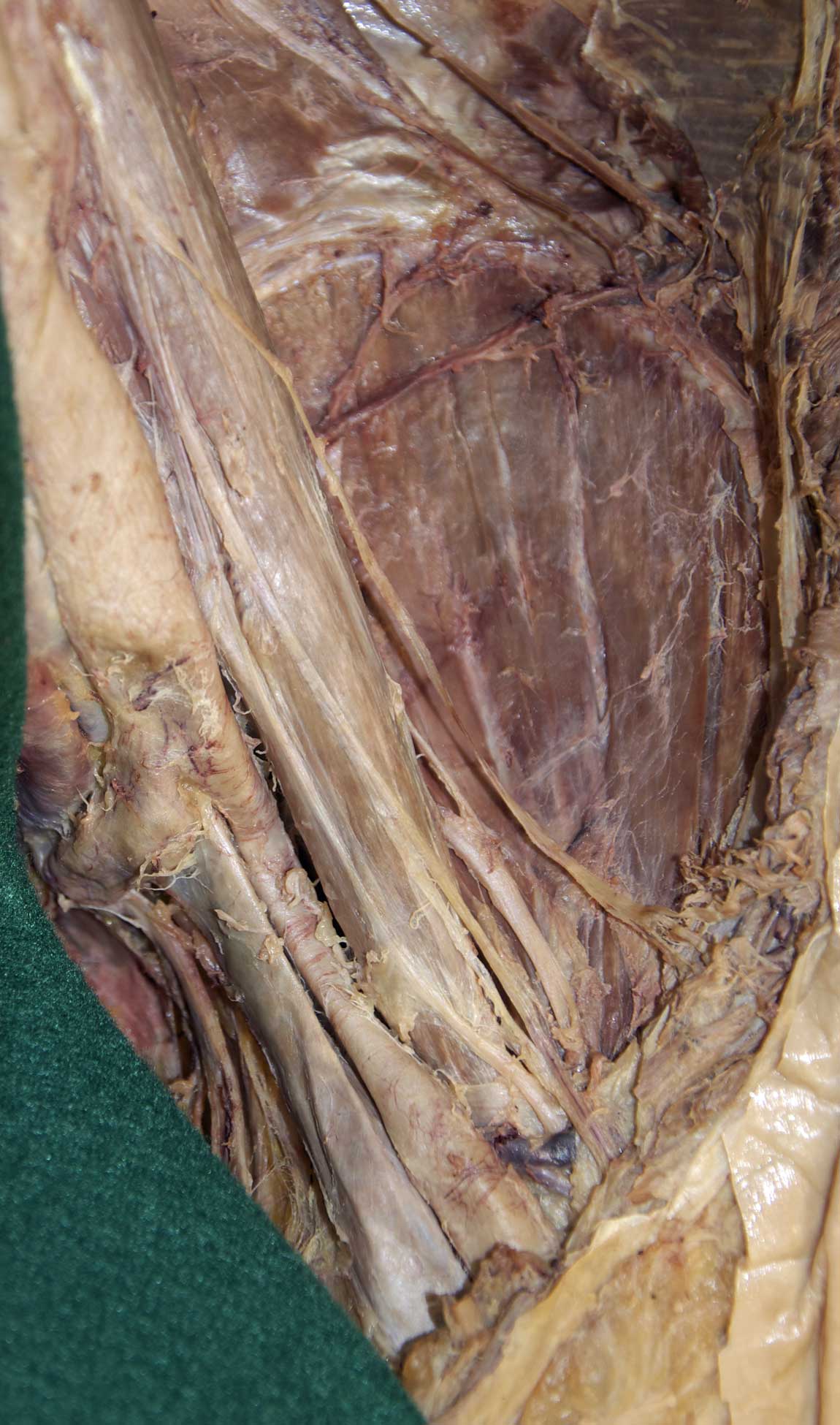 Posterior Abdominal Wall - 1