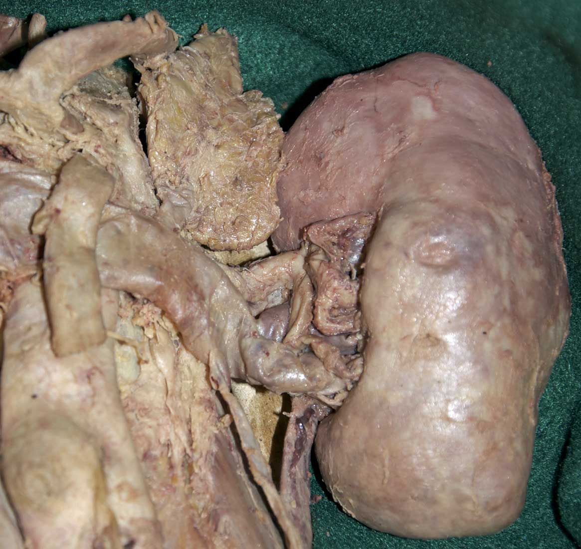 Retroperitoneal Viscera - 2