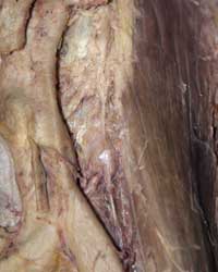 Abdominal Aorta